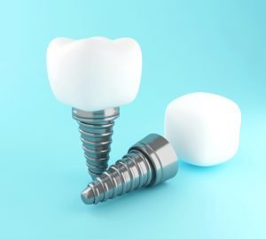 3d dental tooth implant K8W7QWP