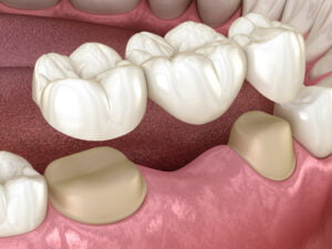 Dental Bridges to replace a single tooths or multiple teeth