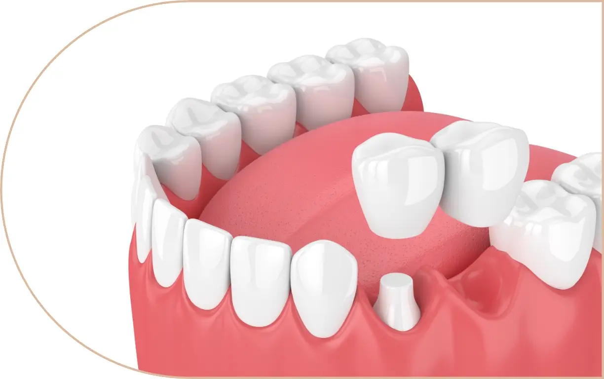 Ceramic Bridge & Ceramic Crowns