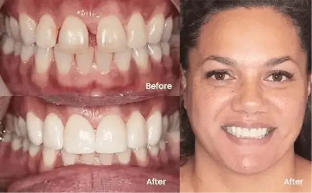 Ceramic veneers Treatment 2 Hinterland View Dental