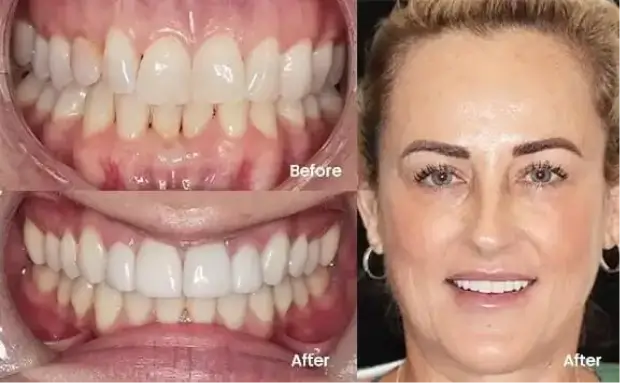 Ceramic veneers treatment Hinterland View Dental