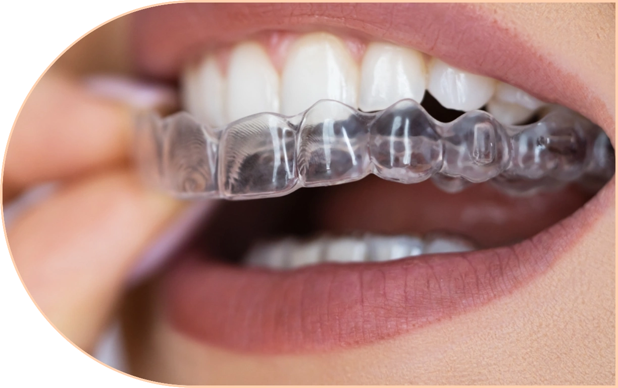 Fix Crooked Teeth