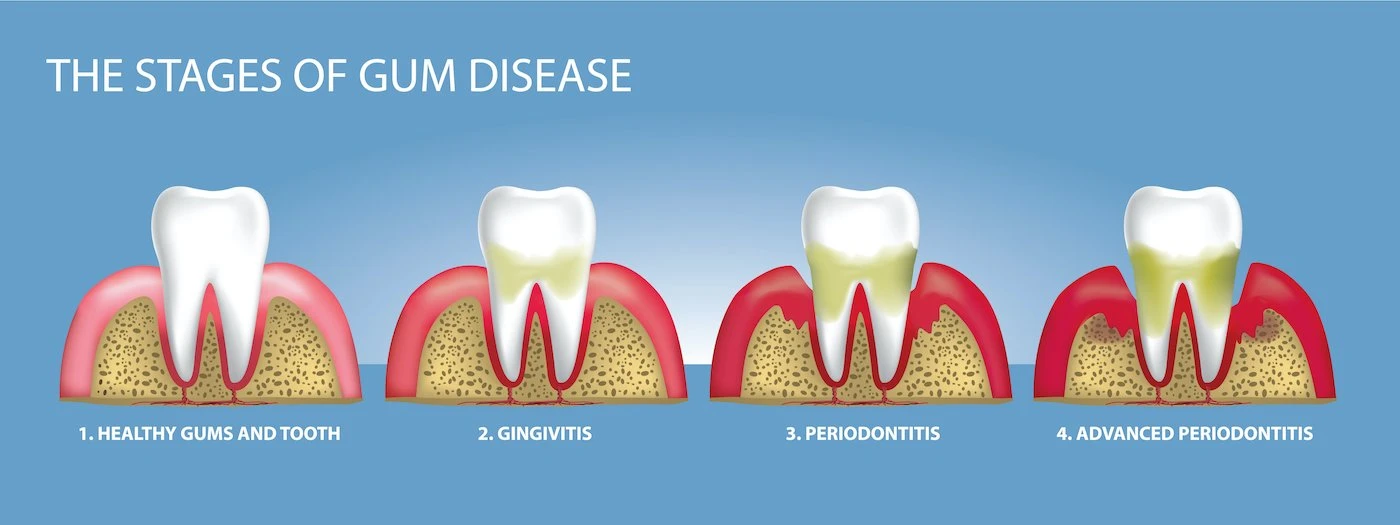 Gum Disease