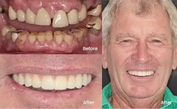 Implants treatment Hinterland View Dental