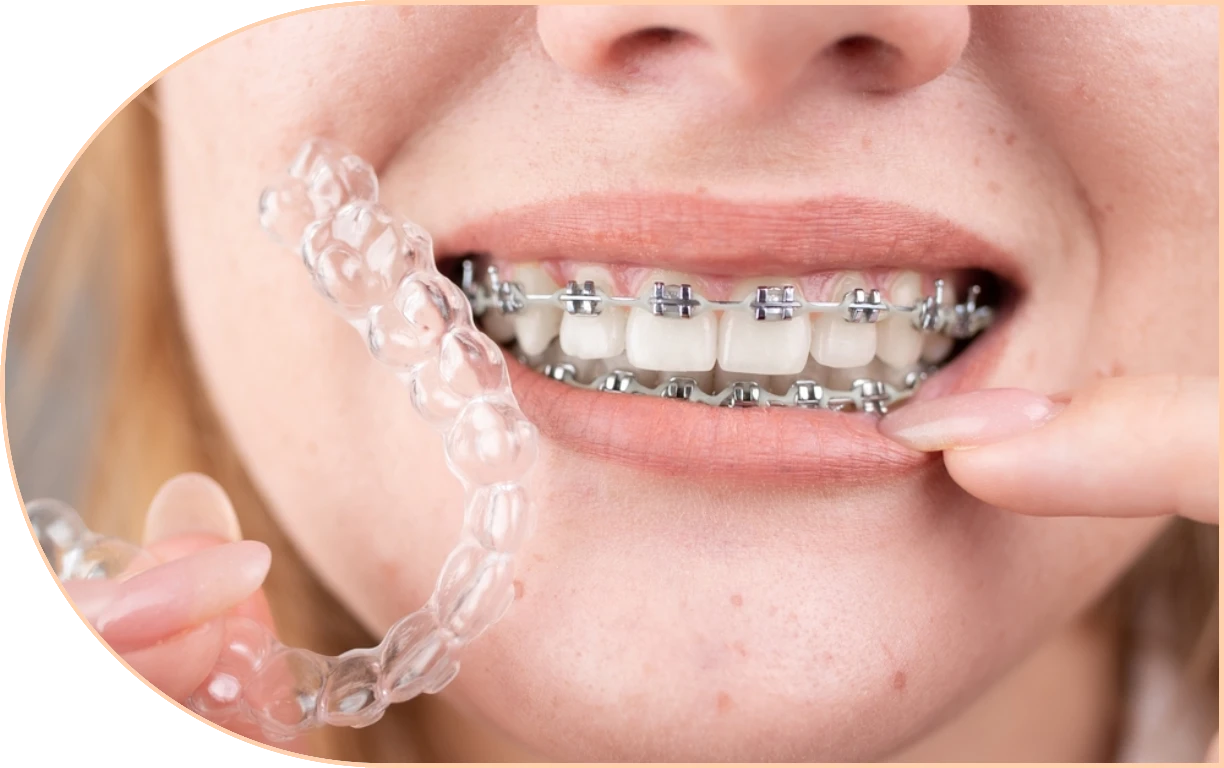 Orthodontic Retainers preserve your new smile