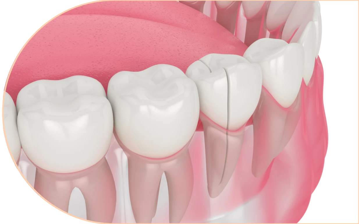 Cracked or broken tooth