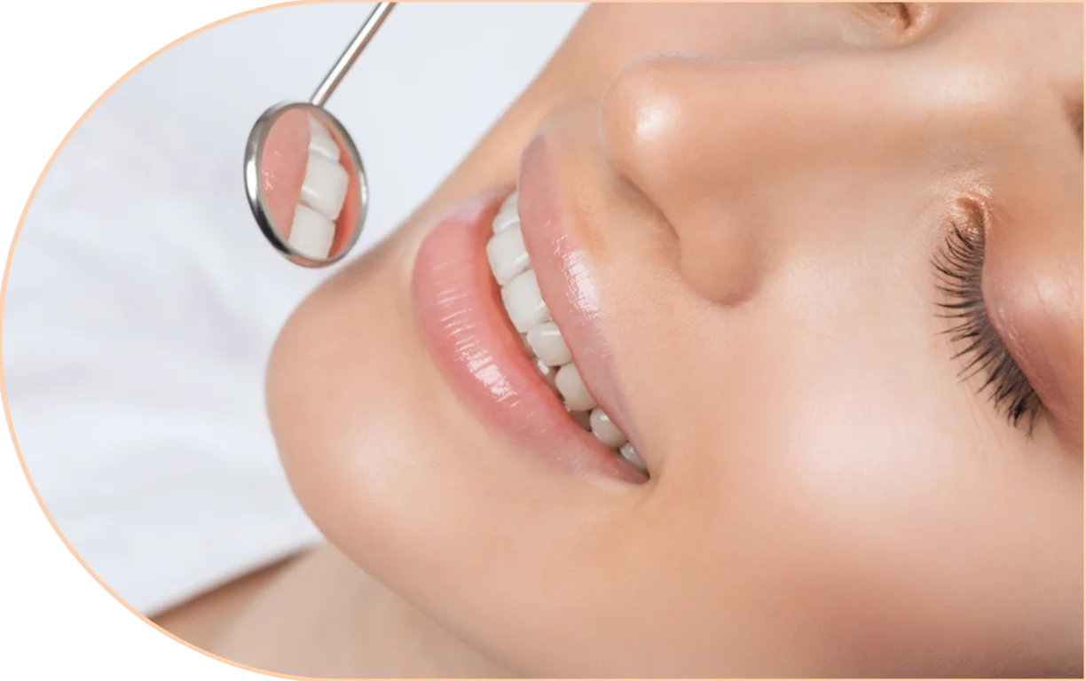 Direct restorations is another term for dental fillings