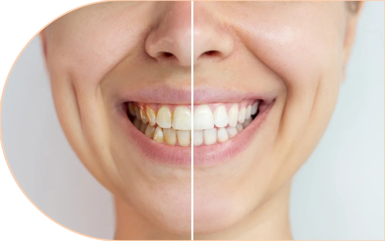 Tooth Coloured Fillings Also known as direct restorations