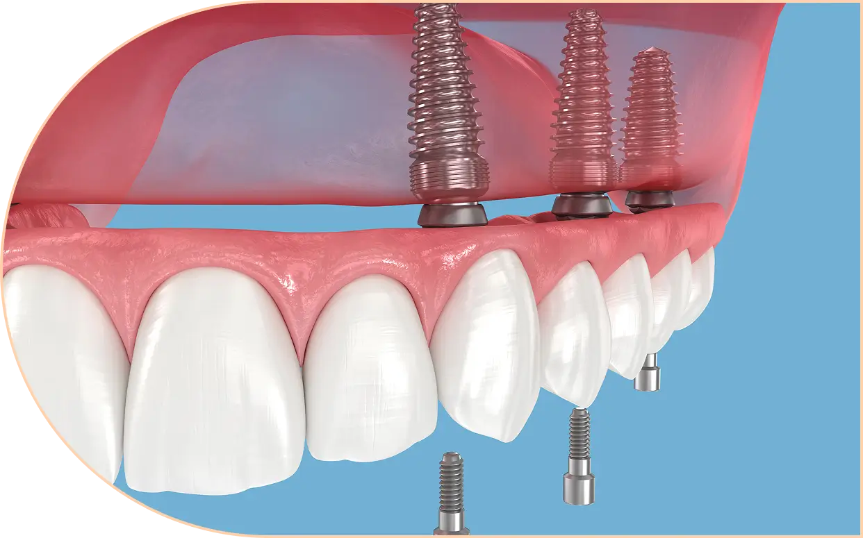 What is a Dental Implant