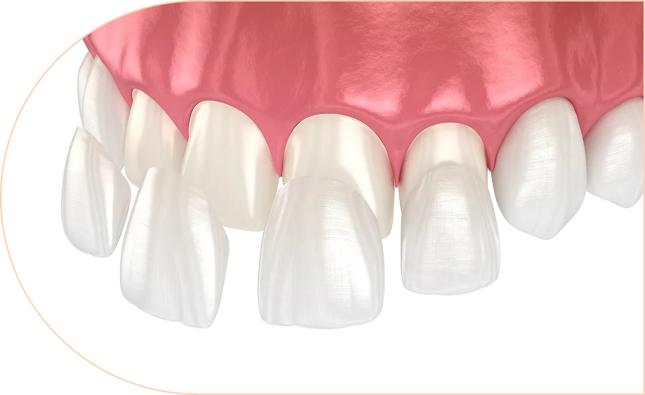 Composite Veneers Hinterland View Dental