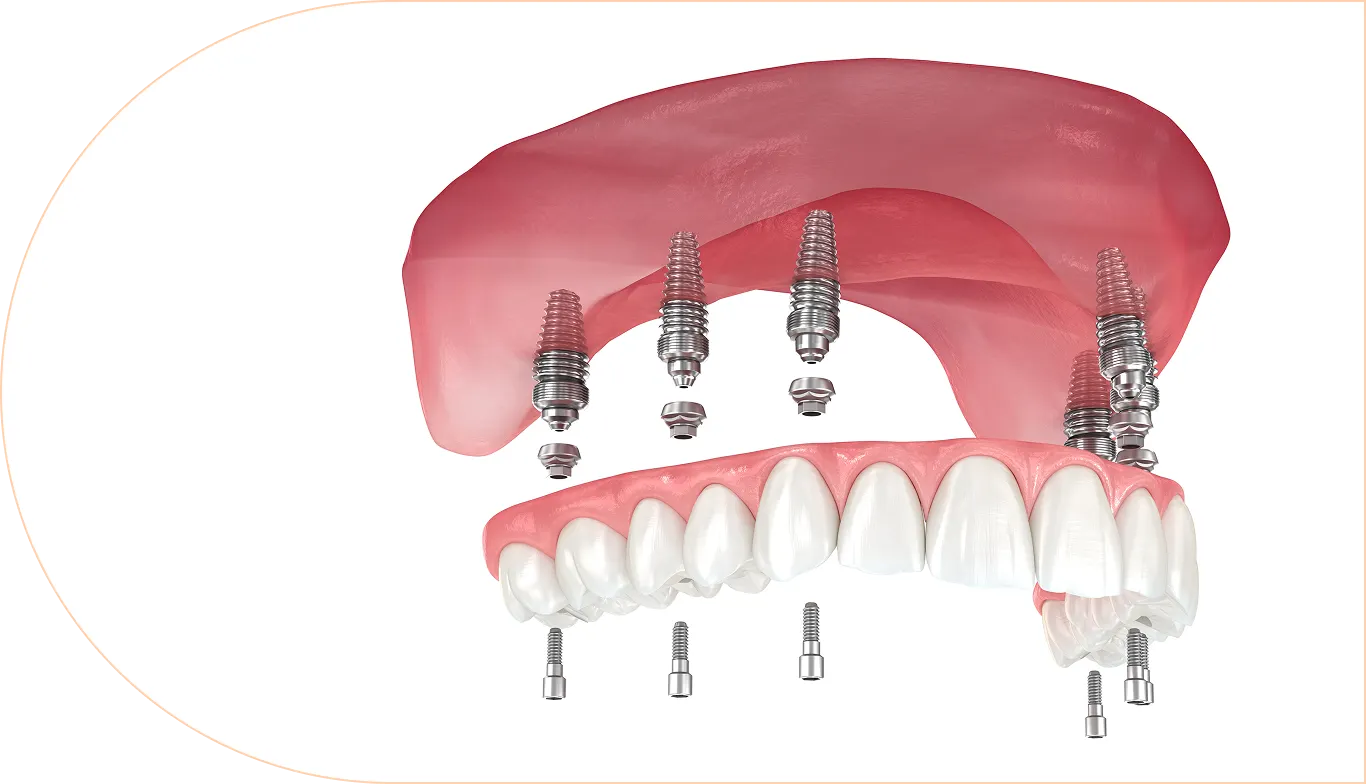 Full ArchSolutions All on X Implant