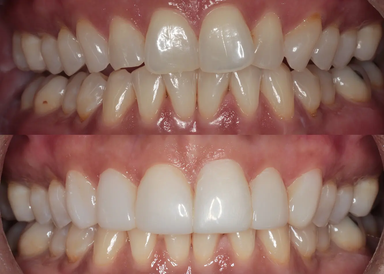 Veneer Before After Case 2
