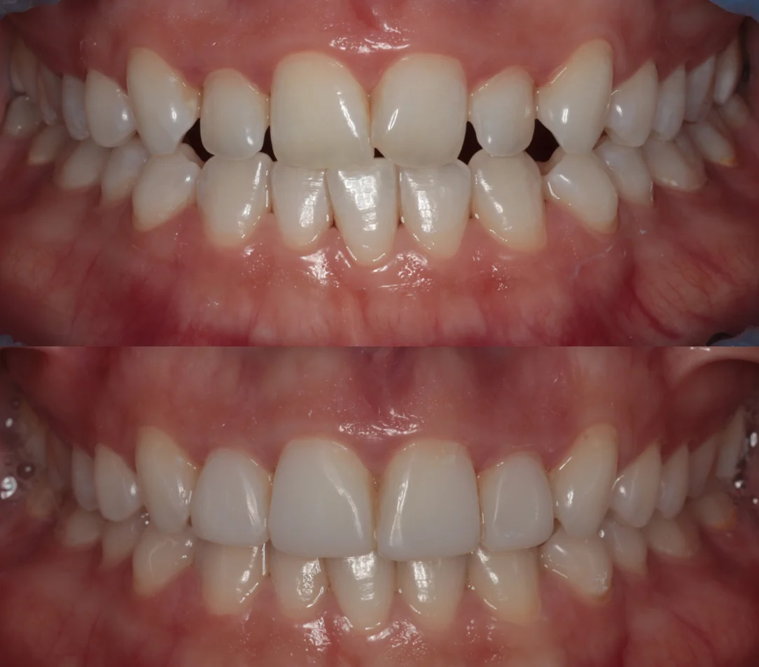 Veneer Before After Case 3