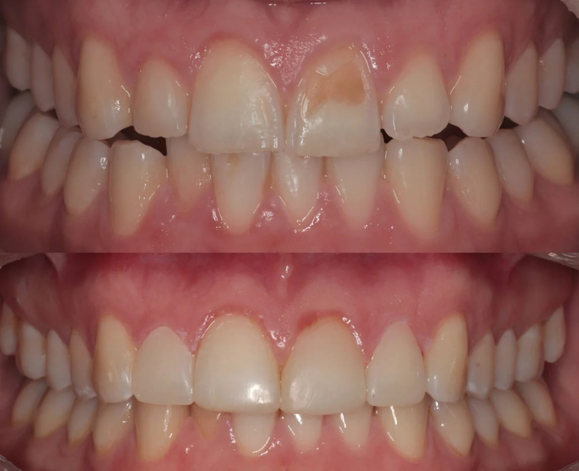 Veneer Before After Case 1